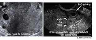 Hoàng Thể Thai Nghén Tồn Tại Bao Nhiều Ngày